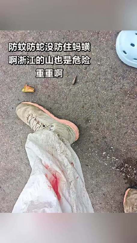 女子爬山被蚂蝗咬伤
