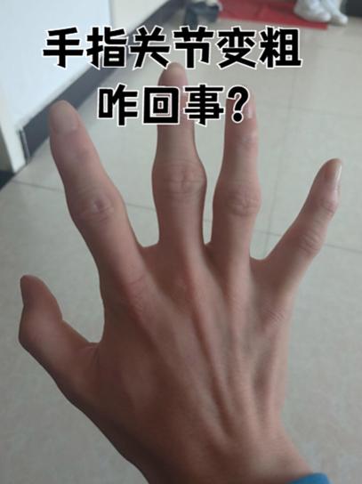 手指关节粗大的原因截图