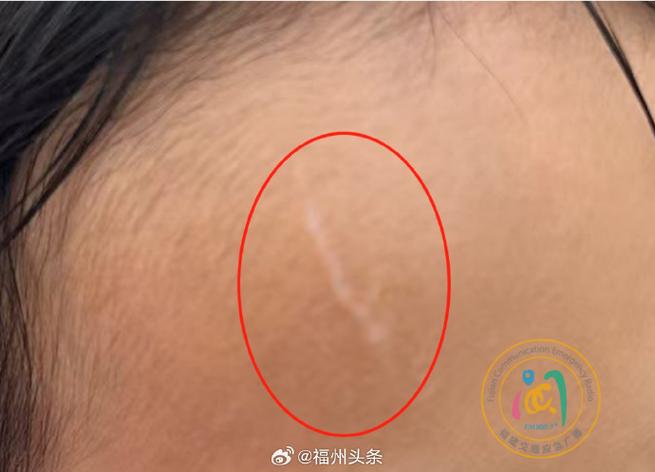 面部1—10级伤残图片