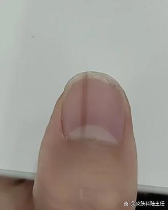 大拇指出现竖纹一条线