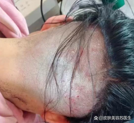 头上长皮肤限制