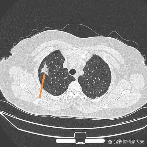 肺癌手术后流鼻血怎么回事