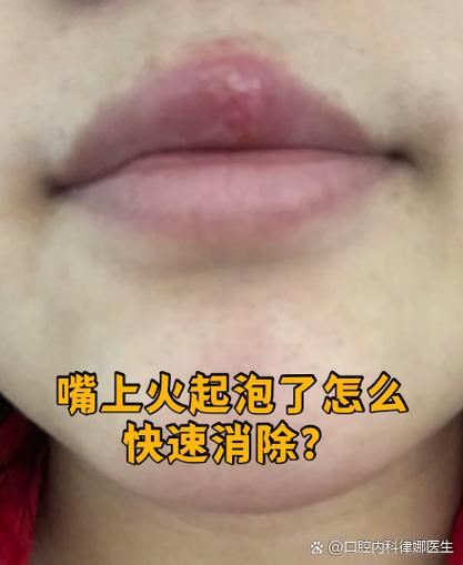 女朋友嘴起泡了怎么办