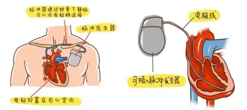 起博器怎么安装视频教程
