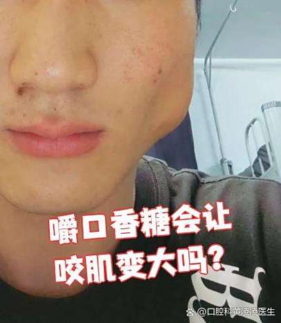 单侧嚼口香糖能改变大小脸吗