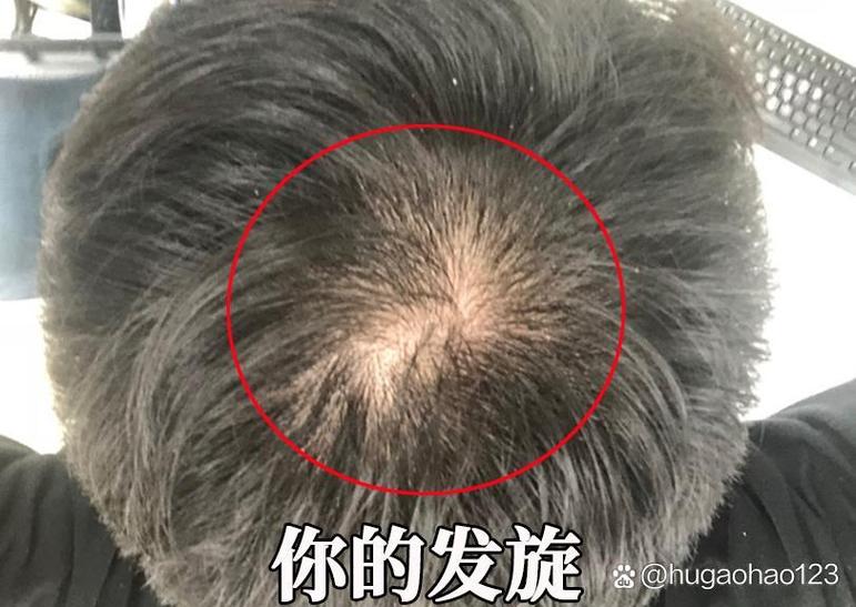 什么样的发旋算脱发