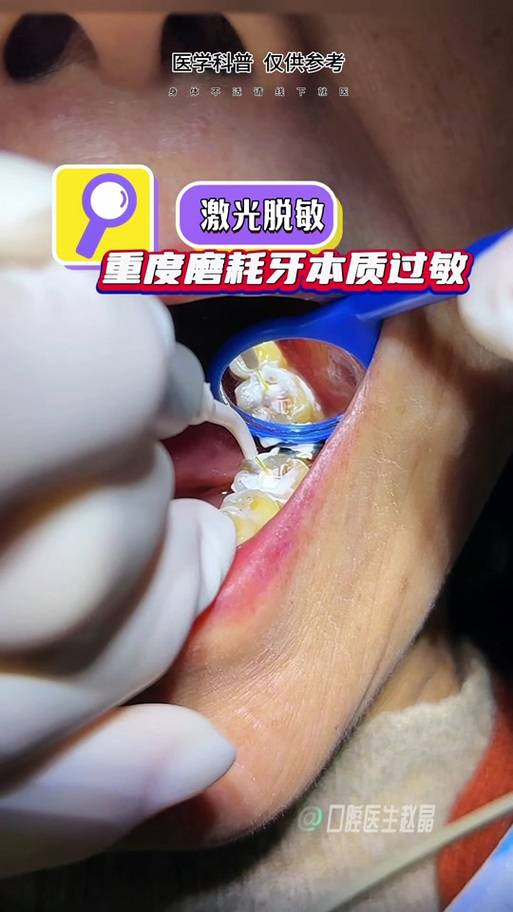 牙齿脱敏治疗是怎么治疗多少钱图标