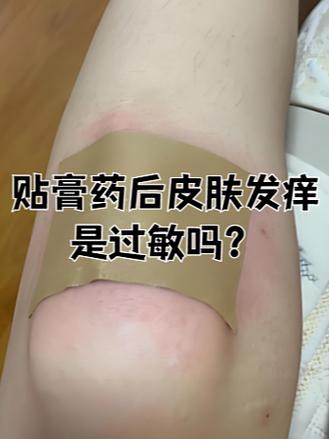 贴了膏药粘的地方发痒