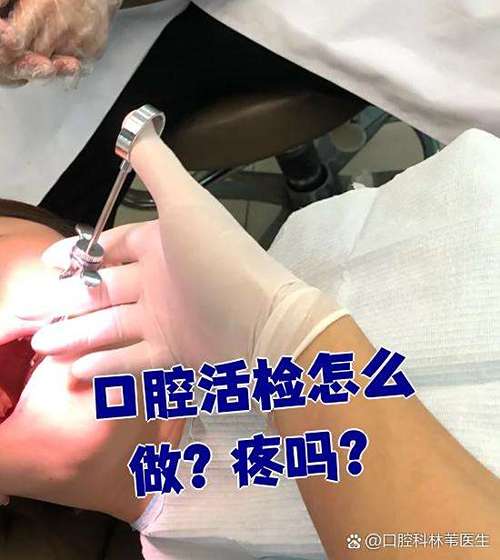 口腔粘膜检查