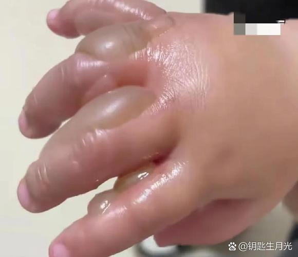 被烫了一下有红印怎么办