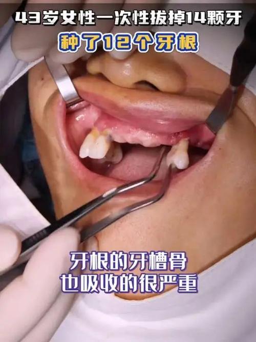 牙齿松动快掉了缩略图