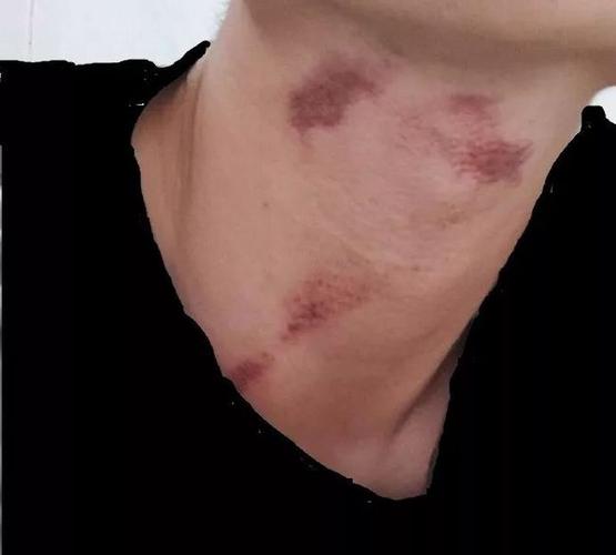 男朋友亲热掐我脖子