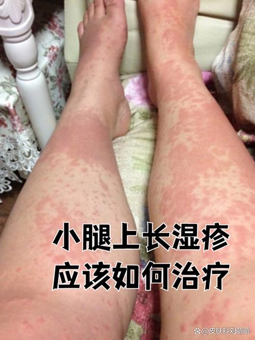 小腿痒是怎么回事