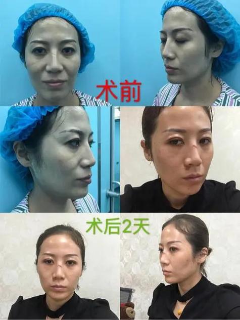 线雕快速恢复原样的方法