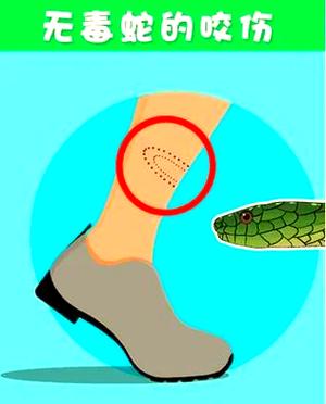 极度异常被蛇咬了怎么办