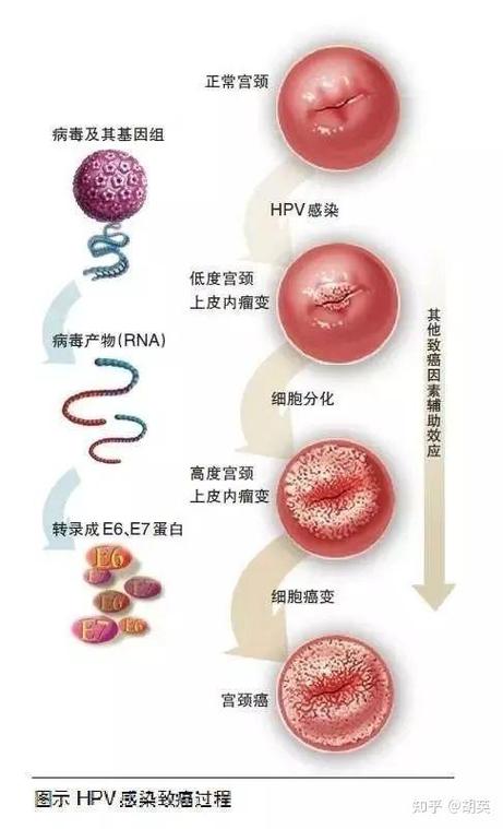 宫颈hpv39阳性是什么意思