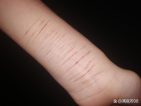 自己割自己手腕算抑郁吗