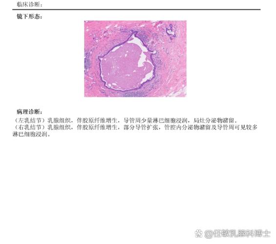 病理AUS是良性还是恶性