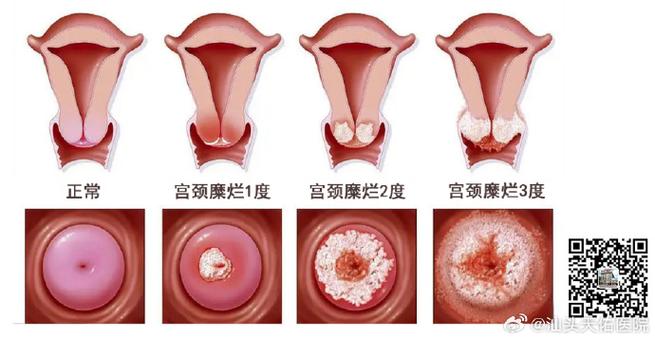 女人妇科炎症几种症状