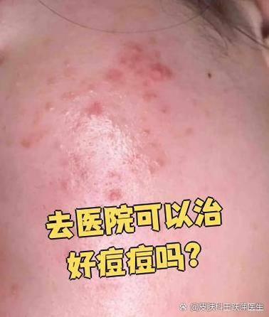 长痘痘有必要去医院看吗