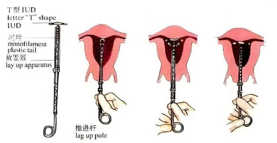 什么是曼月乐环