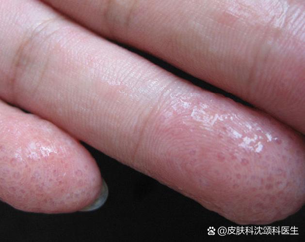 手指脱皮是什么原因