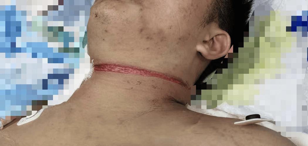 人脖子被拧断会死吗