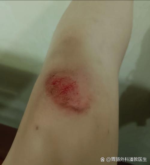 擦伤睡觉时能盖被子吗