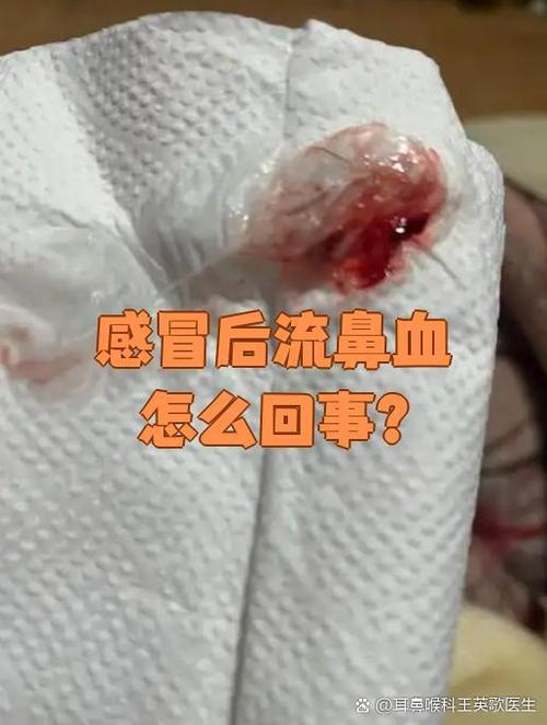 流鼻血次数多什么原因