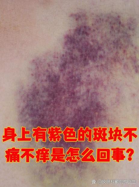 皮肤紫红色斑块图
