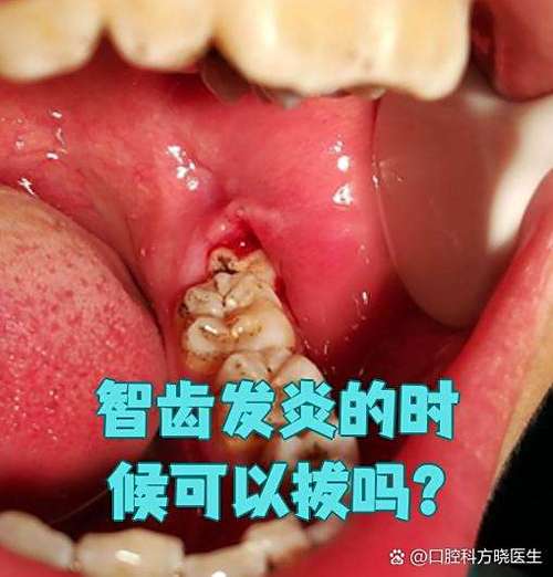 智齿发炎了能拔牙吗缩略图