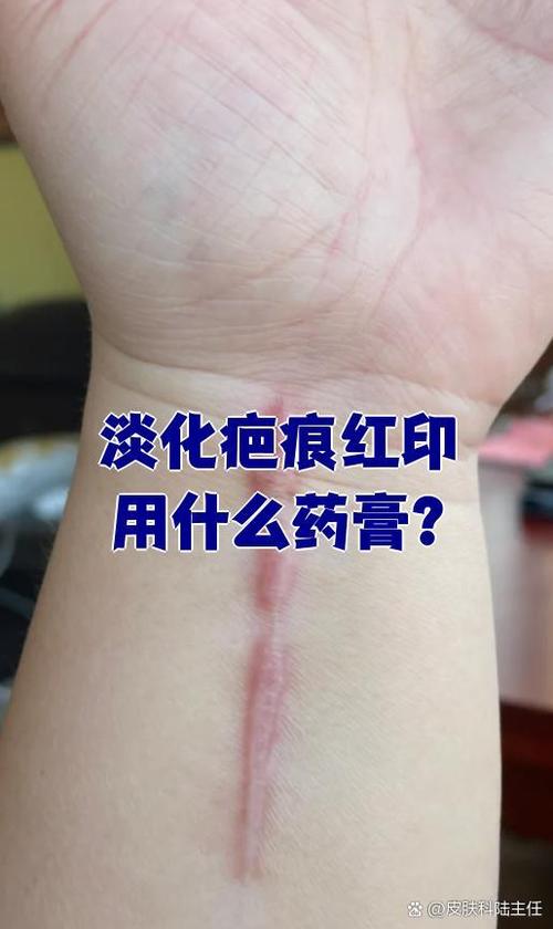 为什么贴药膏会有印记
