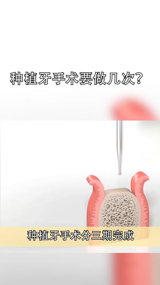 种牙一期疼还是二期疼