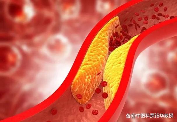 什么清理血管斑块最快