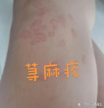 皮肤病100种图片