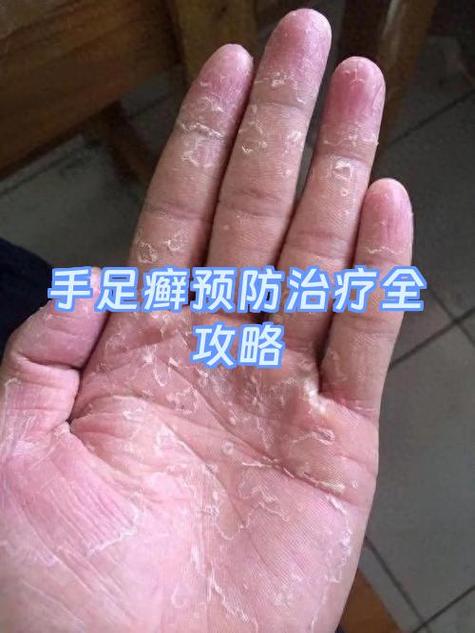 真菌感染怎么治疗