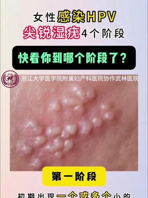 女生hpv感染图片