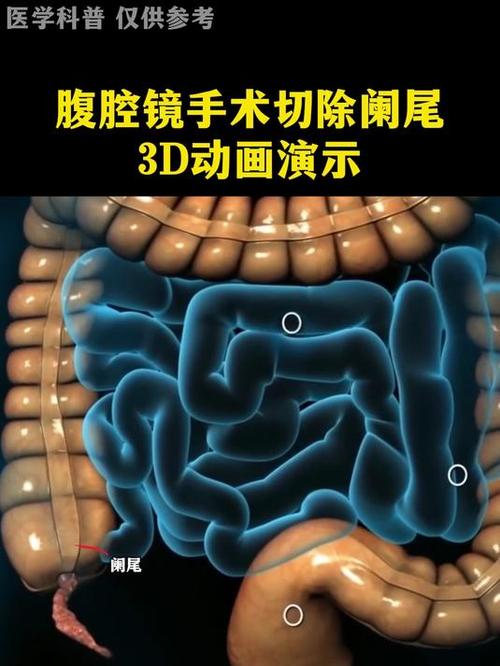 阑尾手术3D演示图