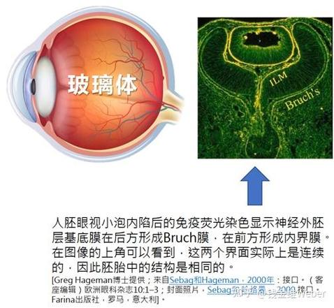 玻璃体后脱离要紧吗