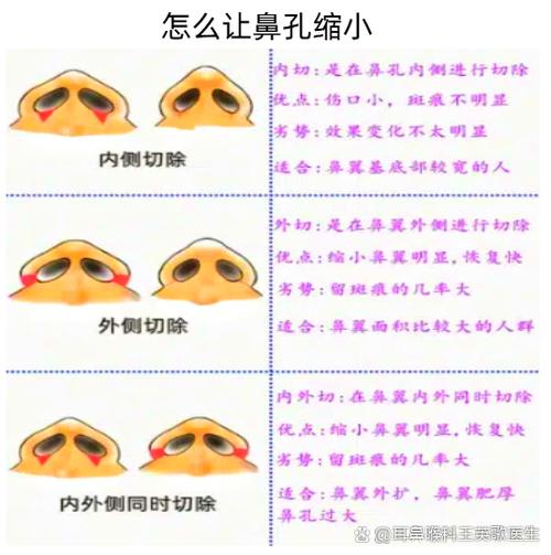 鼻子大怎么变小