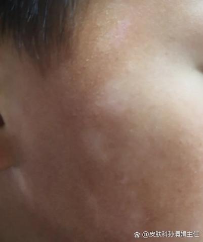 脸上长了一个白色圈的图片