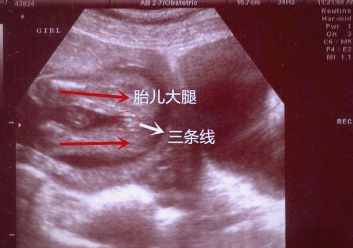 怀孕三个月自测男女