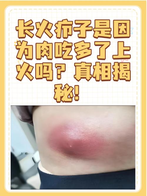 总长火疖子是怎么回事