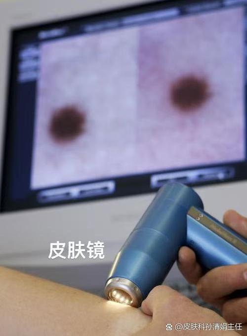 正常的白斑图片图标