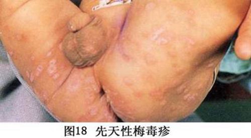 梅毒早期图片