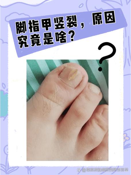脚大拇指有竖纹是什么病