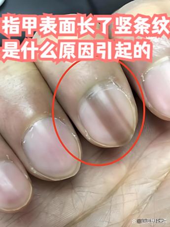 指甲出现竖条纹怎么办