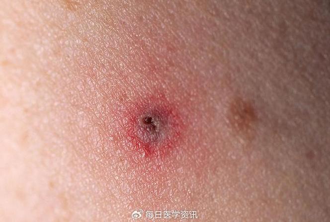 蜱虫叮咬后皮肤图片