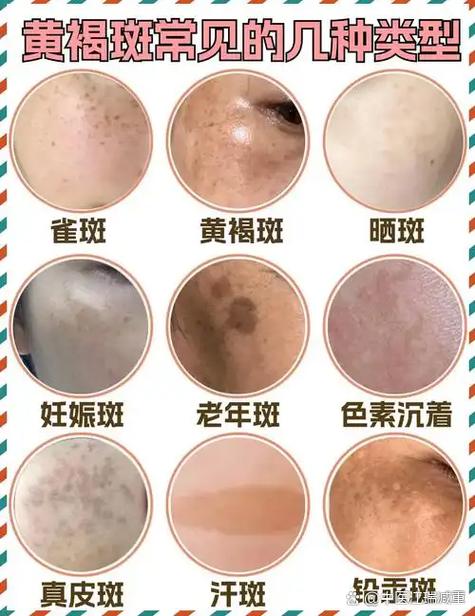 雀斑和黄褐斑的区别
