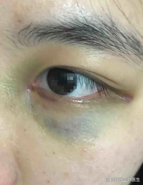 眼睛淤青消除的小偏方图标